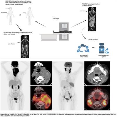 Comprehensive considerations for dermatologists: the application of FDG-PET in evaluating cutaneous lesions in pediatric Langerhans cell histiocytosis
